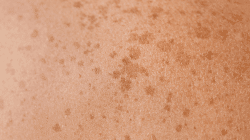 Tretinoin gegen Pigmentflecken?!