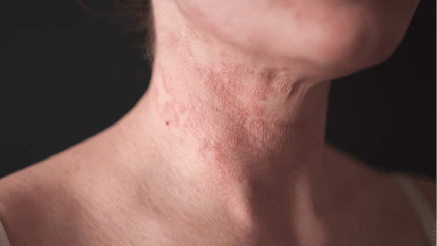 Was mit der Haut während einer Krebstherapie passiert