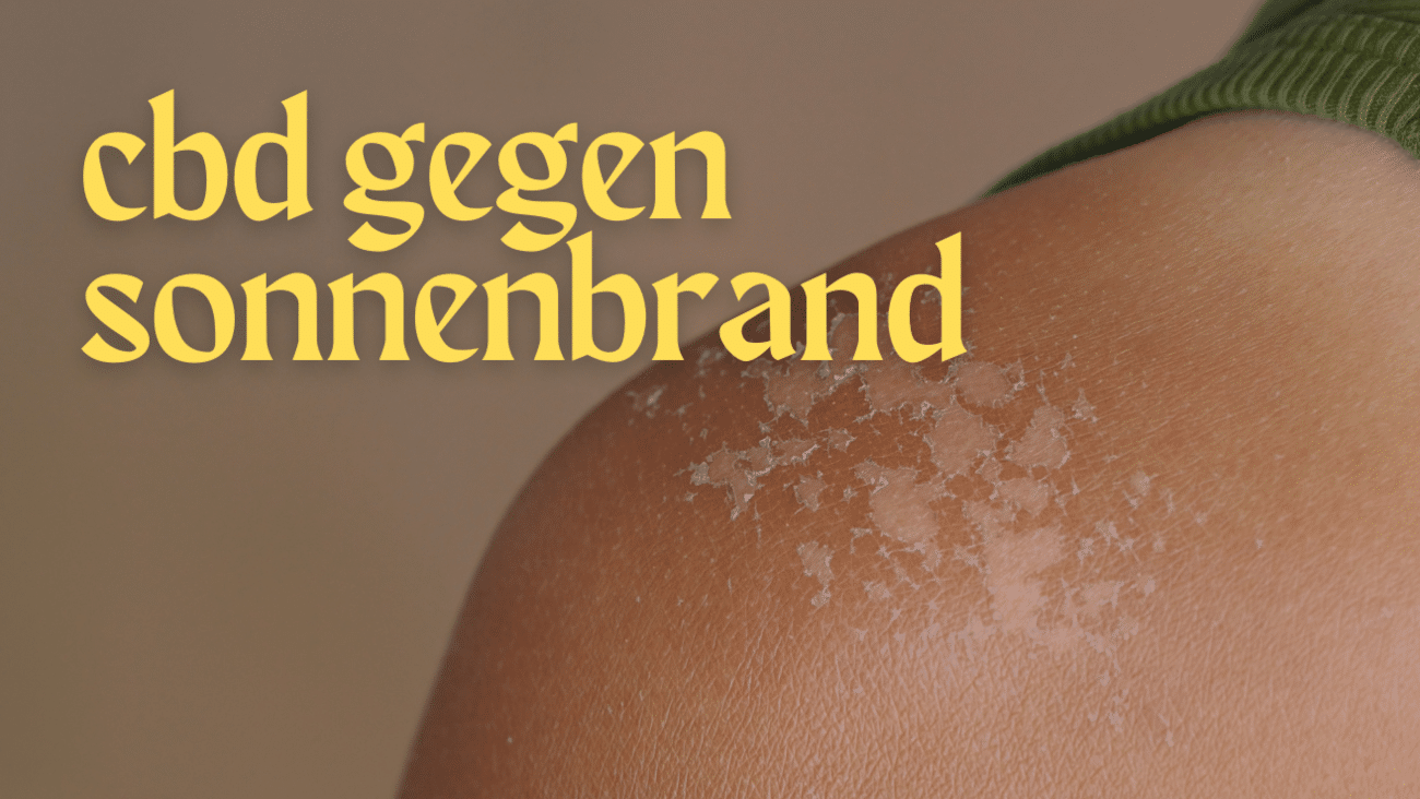 Hilft CBD-Creme gegen Sonnenbrand?
